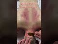Neck Massage #relax #bodypainrelief #cupping #painrehabb #massagetherapy #relaxing #gym #foot #neck
