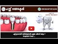 പല്ല് ഉറപ്പായി വയ്ക്കുവാൻ എത്ര ചിലവ് വരും /Implant Cost/Part - 2/Video by Dr.Thomas Nechupadam