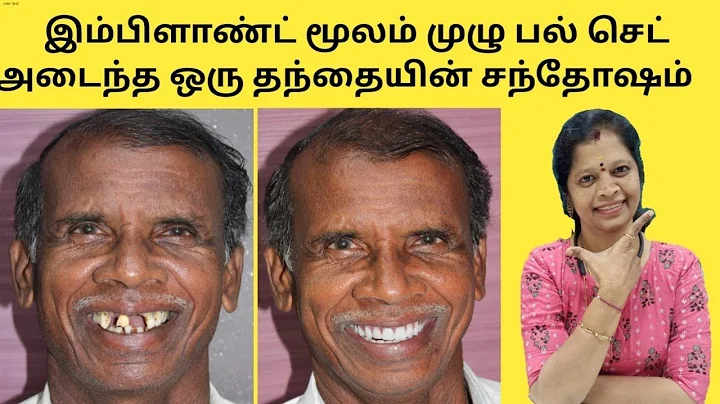 பிக்சடாக இம்பிளான்ட் மூலம் முழு பல் செட் - 3 நாட்களில். Fixed full teeth with dental implants