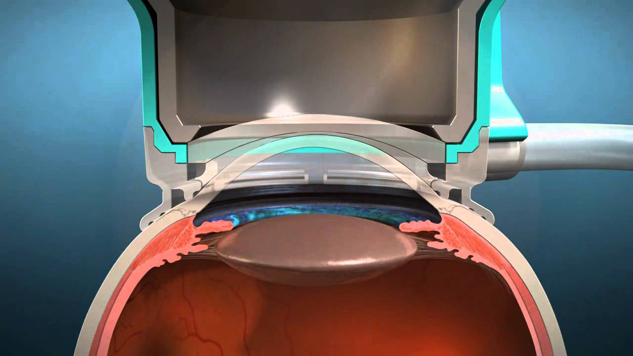 Femto-Fako LenSx | Oční klinika Horní Počernice