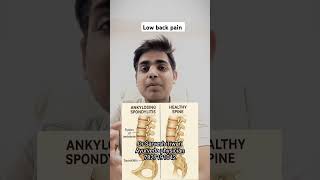 #youtubeshorts #ankylosingspondylitis #viralshorts #trendingshorts #ayurveda #lowbackpain