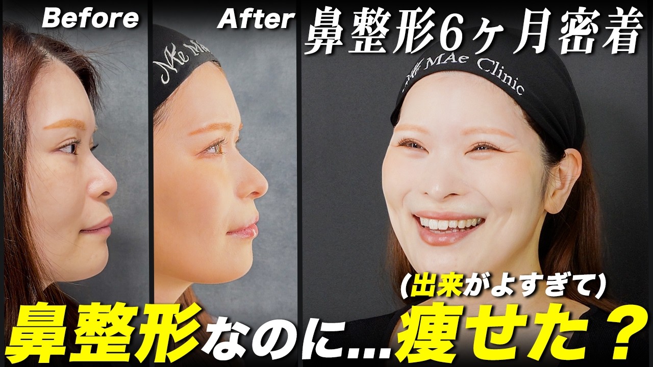 鼻形成術　Rebuilding Nose 6-Month Follow-Up] How to Achieve a Natural-Looking Nose: Rib