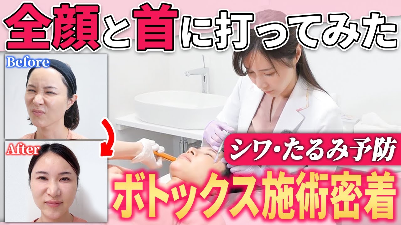 ボトックス施術のリアル｜打ち方と自然に仕上げるポイントを徹底解説