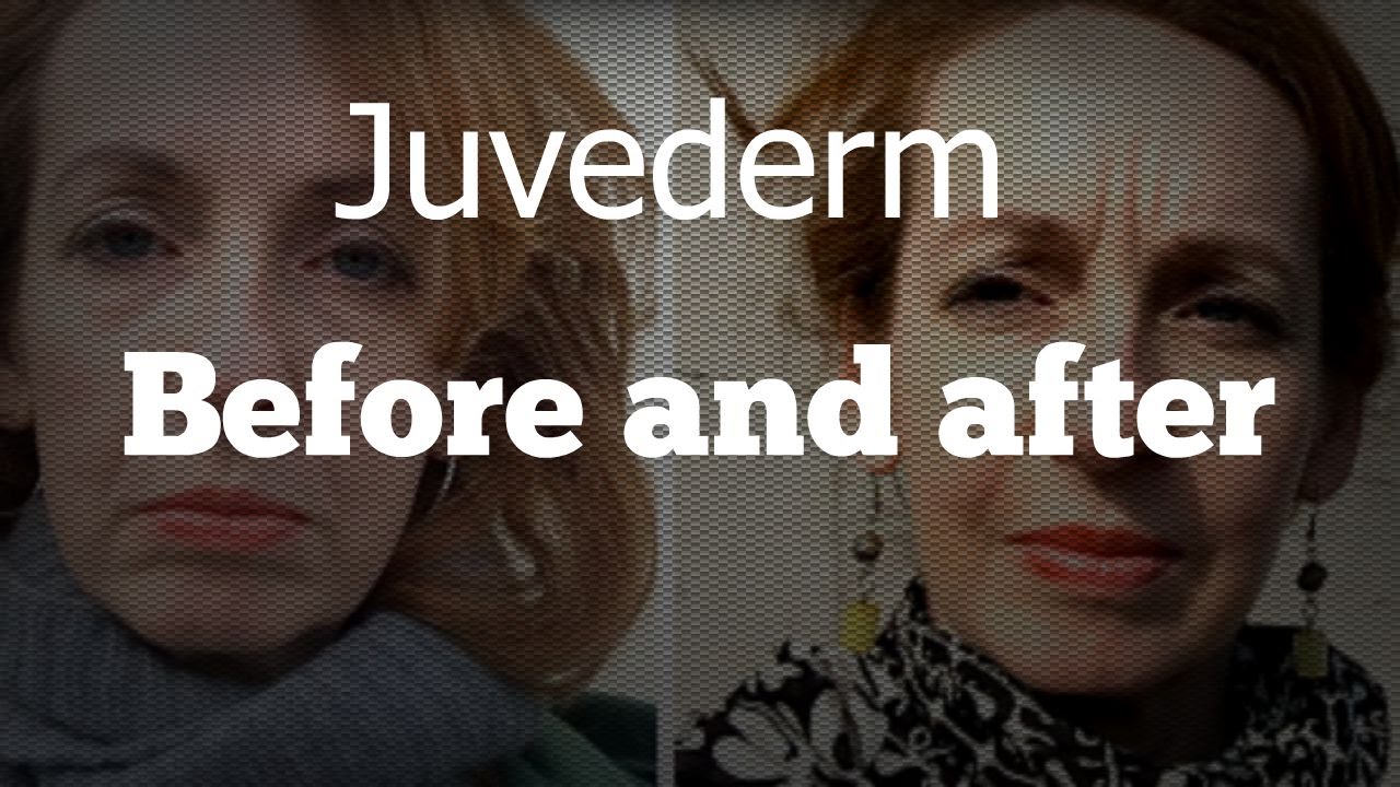 Juvederm: Before and after