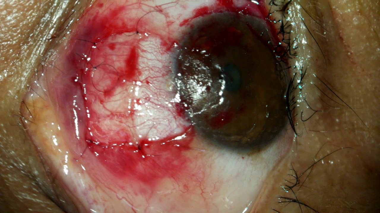 Cirugía Pterigion - YouTube