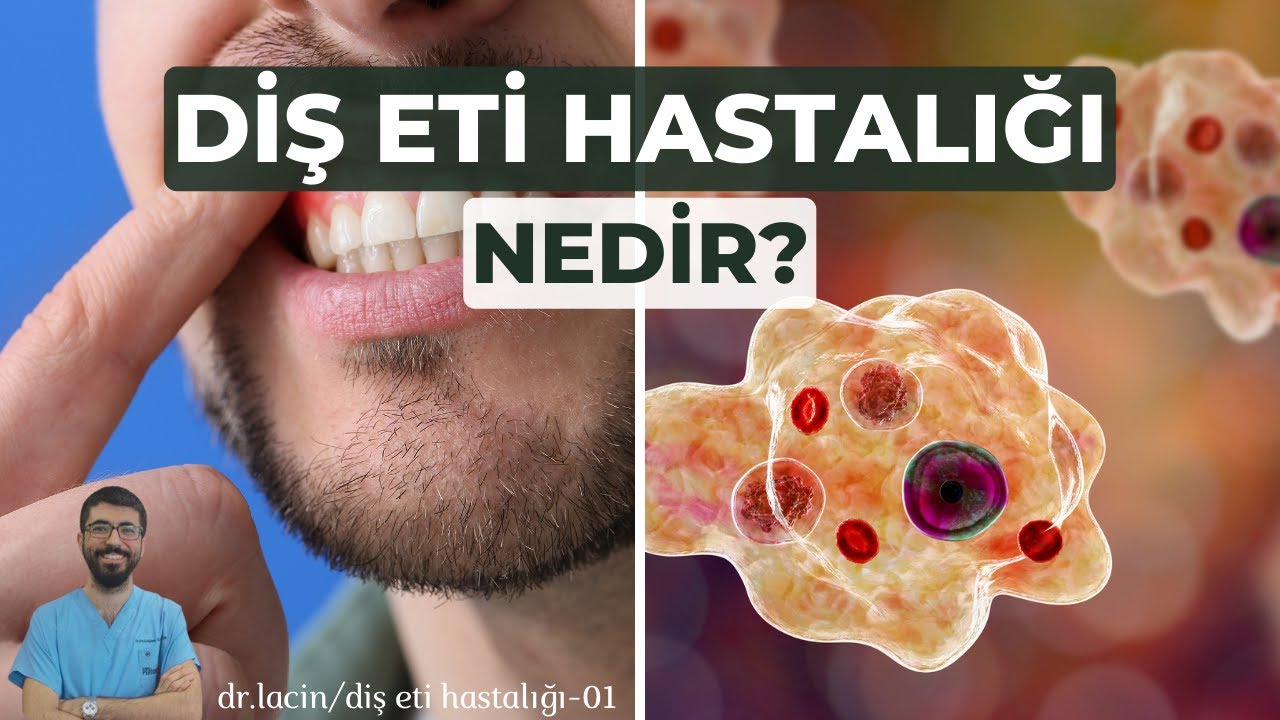 Что такое заболевание десен? | Др. Лачин | Болезнь десен - 01