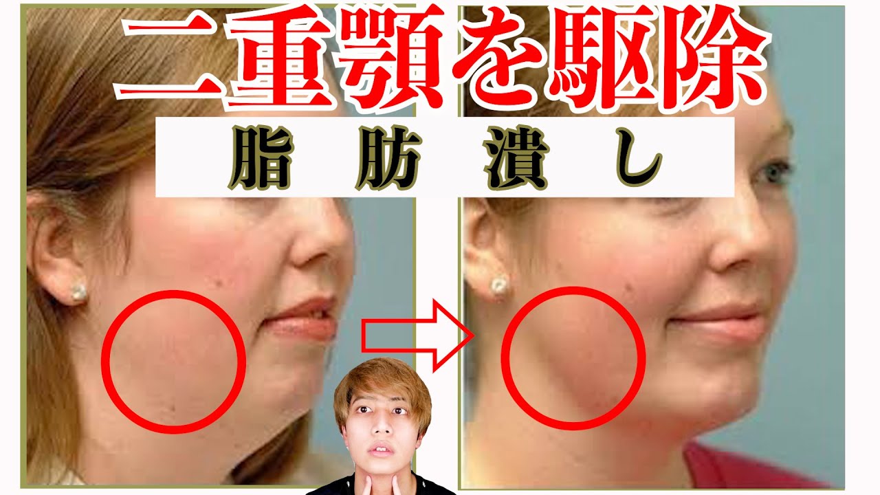 4分 二重顎をなくしてフェイスラインをスッキリさせた方法 Double Chin Youtube