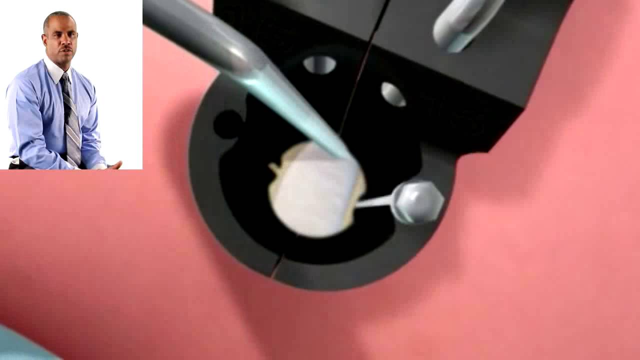 William Stevens, MD talks about Direct Lateral Interbody Fusion