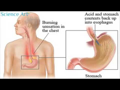 რეფლუქს-ეზოფაგიტი