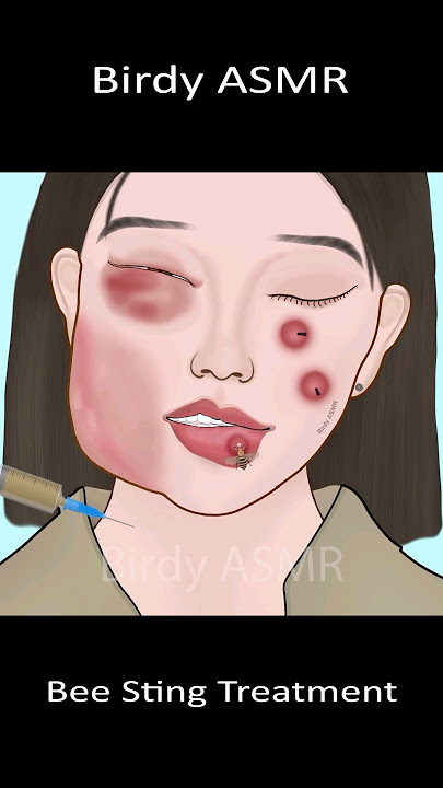 ASMR Treatment Bee Sting #asmr #satisfying #viralvideo #trending #shorts