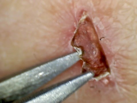 Magnified Scab Picking 2