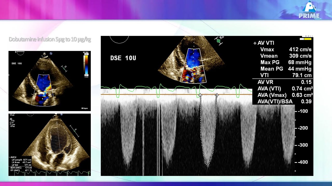 Аортальный стеноз с низким кровотоком: просто и понятно