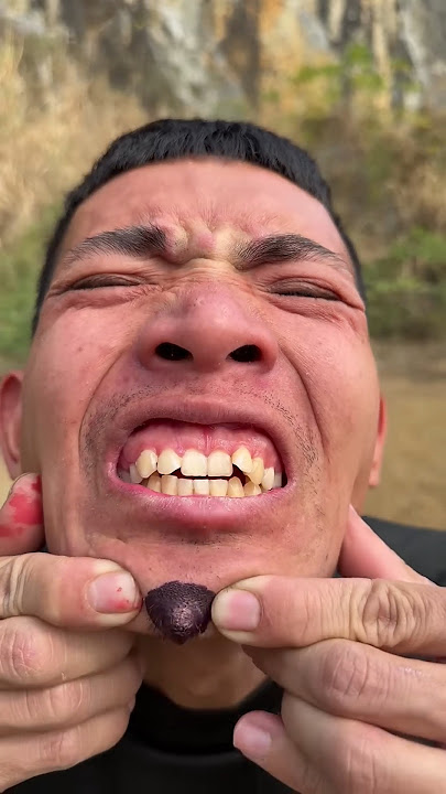 How I Cured a Bug Bite with Yogurt in the Wild | Survival Hacks #1589187