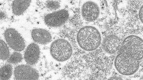 Monkeypox: How you can protect yourself from the virus and what to do if you have symptoms