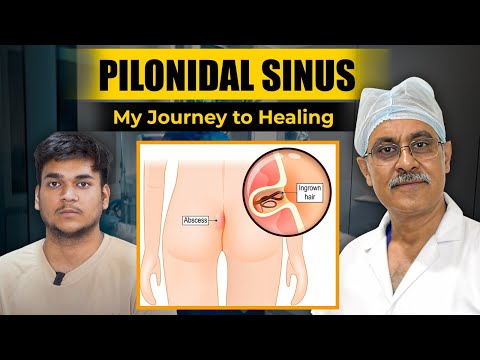 Pilonidal Sinus |