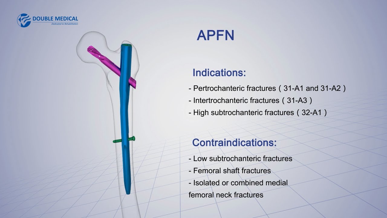 Proximal Femoral Nail Long 135 | Uteshiya Medicare