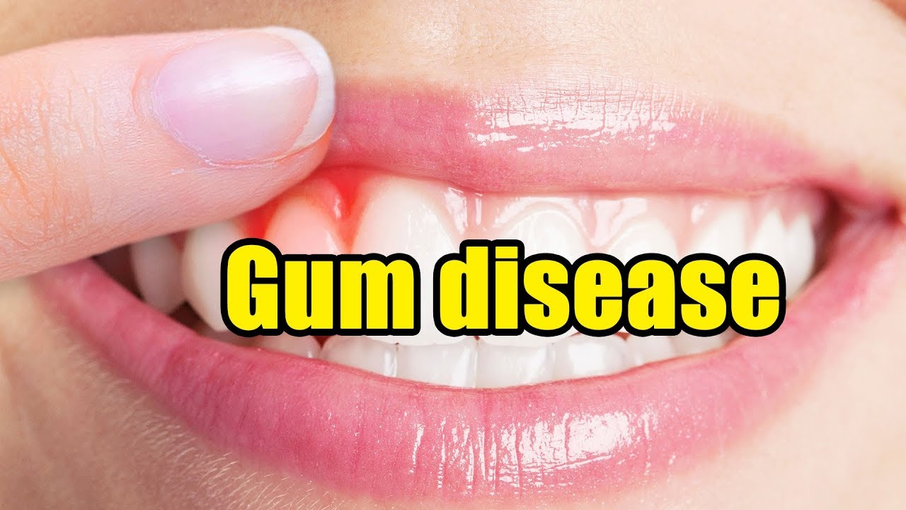 How To Get Rid Of Bad Breath Gum disease is a common cause of bad