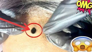 blackheads extractions  | blackheads extractions  |