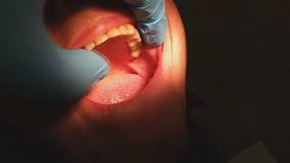 Протезирование пациентки &quot;С&quot; бюгельными протезами. 4-я стоматология.