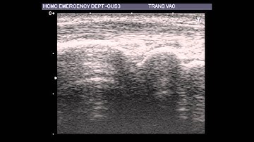 Ultrasound Guidance in the Reduction of Closed Distal Radius Fractures