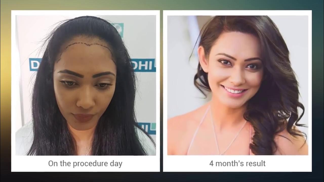 Female Hair Transplant Miss Srilanka Yureni Noshika’s Hair transplant