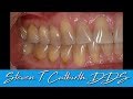 Bonding Gumline Abfraction - Dental Minute with Steven T. Cutbirth, DDS