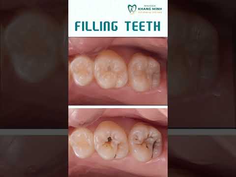 Filling Teeth shorts orthodontist dentist by Nha Khoa Khang Minh