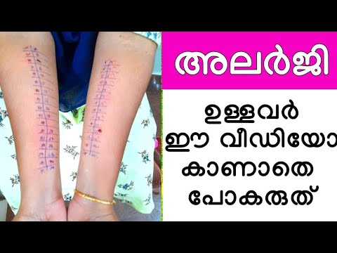 Allergy Skin Test//Allergy test skin prick/അലർജി പെട്ടെന്ന് സുഖപെടുത്താം //How to allergy testing//