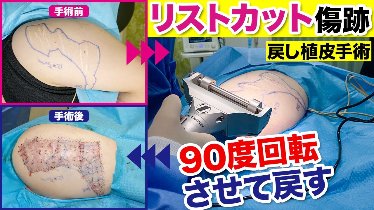 リスカ の 跡 を 消す 方法
