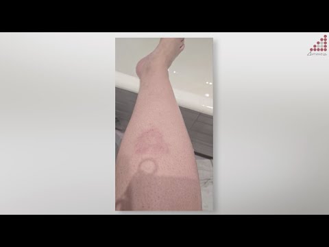 Хвороба Лайма як звичайний укус може обернутися діагнозом