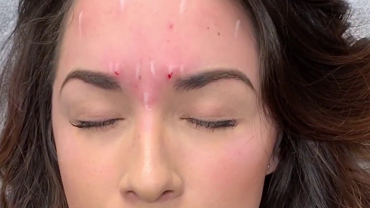 Allergan Botox Treatment YouTube