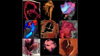 FETAL ARRHYTMIAS :   Part 3- In Utero Management