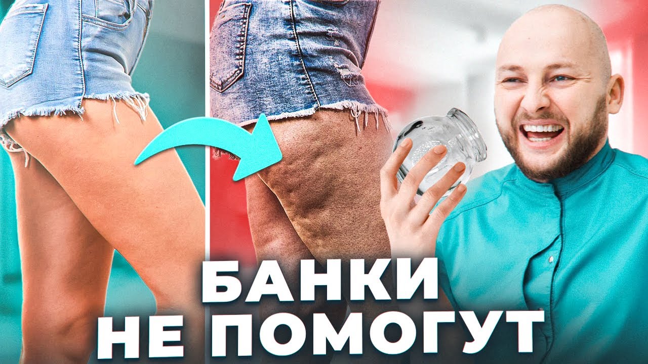 Вся правда про целлюлит | Самые опасные способы лечения | Косметология ...