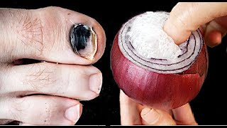 Cure Toenail Fungus For Less Than $1 in under 2 minutes! You must do it!