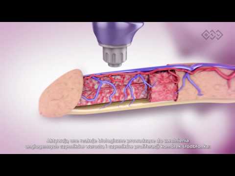 Videó: Potenciális Terápiás Stratégia: A Mitokondriális Diszfunkció Kezelése Szepszisben
