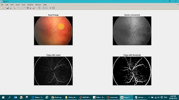 Retina Blood Vessels Detection Matlab
