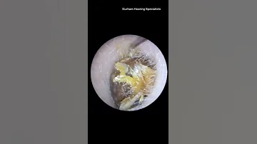 How Hard Ear Wax Is Cleaned Out Shorts 