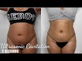 Ultrasonic Cavitation & Laser Lipo | Before and After photos| Full Detailed Video