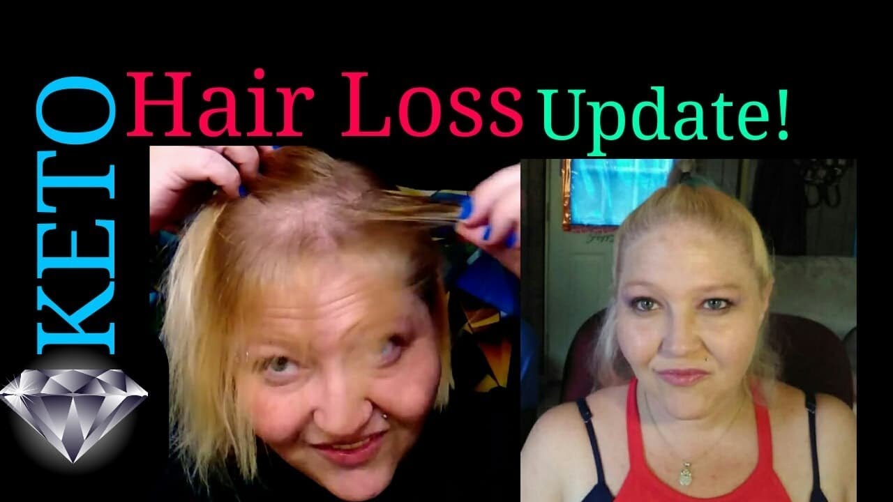 KETO Hair Loss Update YouTube