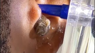 Removal of wax plug in the ears_satisfaction and relaxation_удаление серной пробки в ухе