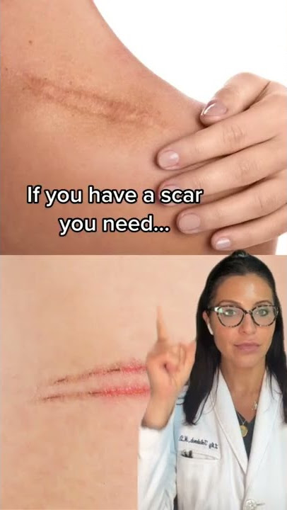 How To Treat Scars According to a Dermatologist #shorts