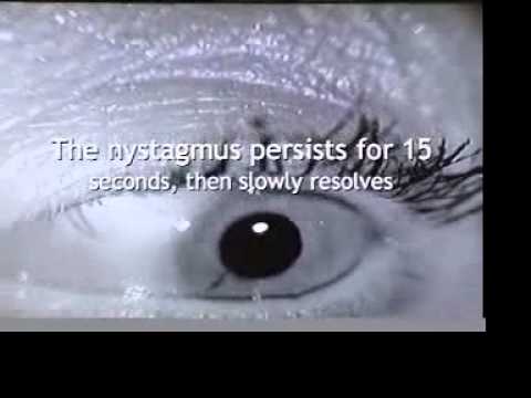 Video: Nystagmus - čo To Je? Typy A Metódy Liečby Nystagmu