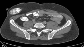 КТ брюшной полости. Илеостома.(Пациент мужчина 55 лет, в 2008 году ему была выполнена колэктомия по поводу рака толстой кишки и диффузного..., 2010-05-22T20:38:37.000Z)