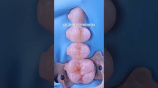 Direct Composite Restoration Прямая Композитная Реставрация