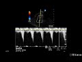 How to measure lvot obstruction