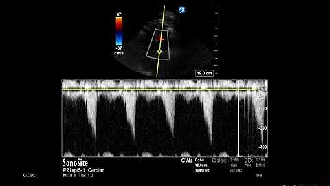 How to... Measure LVOT Obstruction