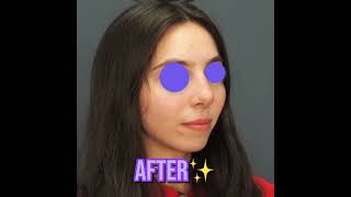 Breathe Better, Live Better 👃✨ | Before &amp; After Rhinoplasty + Septoplasty