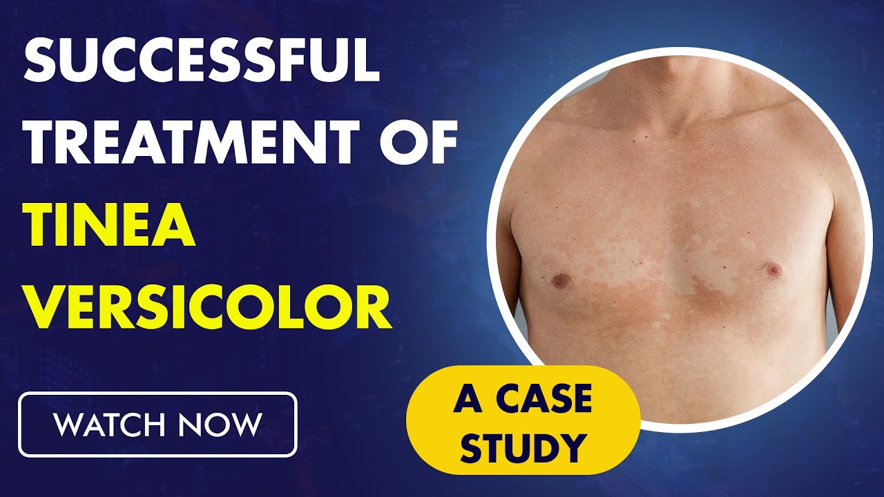 Successful Treatment of Tinea Versicolor with the Help of Ayurveda A