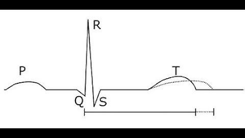 ECG in Toxicology_Dr Pradeep Rangappa