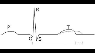 ECG in Toxicology_Dr Pradeep Rangappa